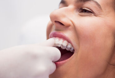 Clear Aligners