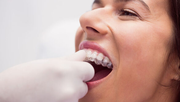 Clear Aligners