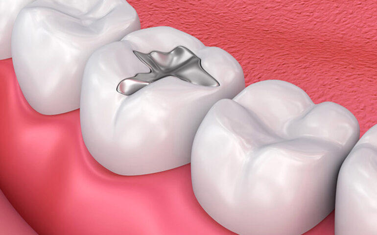 Dental-Filling-Specialist-in-Gandhinagar