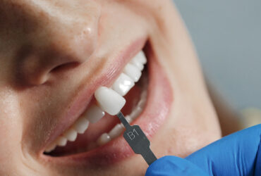 Dental Veneers