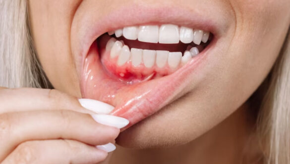 Gum Infection Treatment
