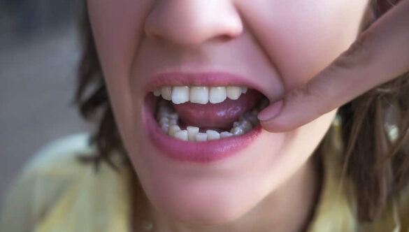 Misaligned Teeth Treatment