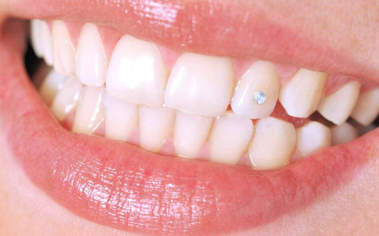 Teeth Jewellery Treatment in Ahmedabad