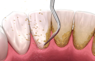 Teeth Scaling, Deep Cleaning, Root Planning