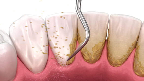 Teeth Scaling, Deep Cleaning, Root Planning
