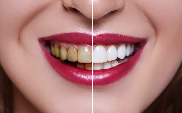 Teeth Whitening Treatment in Ahmedabad