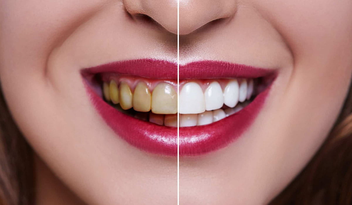 Teeth Whitening Treatment in Ahmedabad