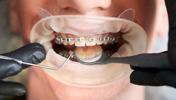 Dental Braces Treatment and Why it is important???