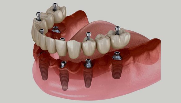 What is dental implants? Why dental implants?