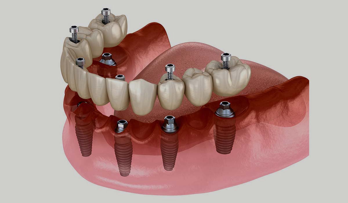 What is dental implants? Why dental implants?