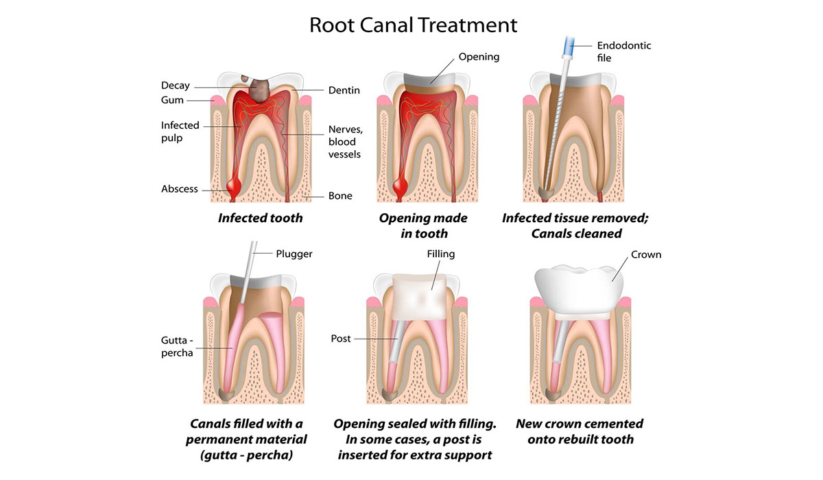 root-canal-treatment-gandhinagar-painless-beat-clinic-nova-dental-hospital